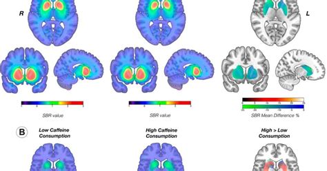 parkinson's disease part of brain affected
